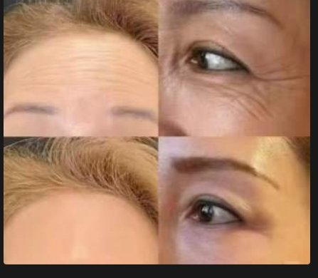 额部及眼周除皱前后对比 Forehead & eye area before/after
