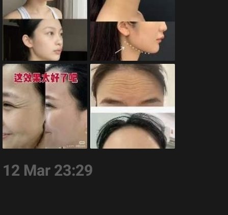 下颌线及除皱前后对比 Jawline & wrinkle before/after